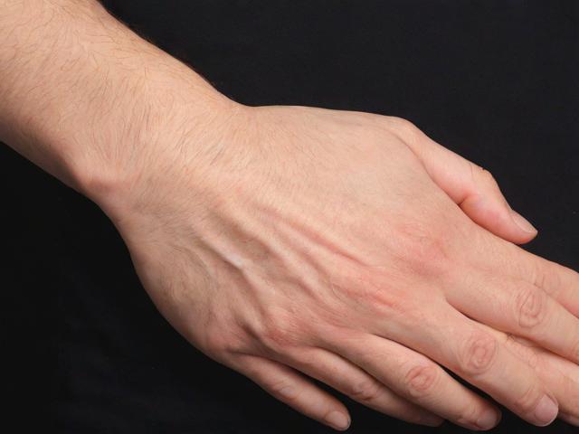 郑州腋臭微创手术多少钱？郑州腋臭治疗费用全解析